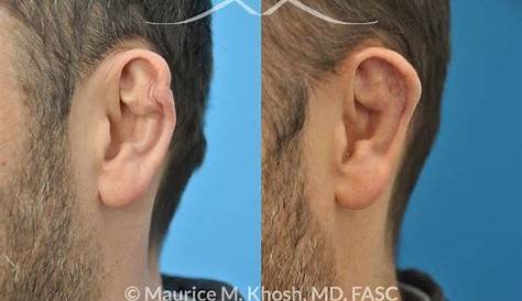 Cauliflower Ear Repair