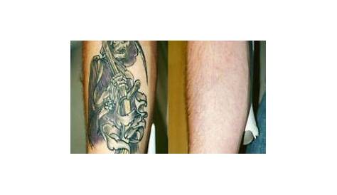 Huntsville Tattoo Removal | Advanced Dermatology