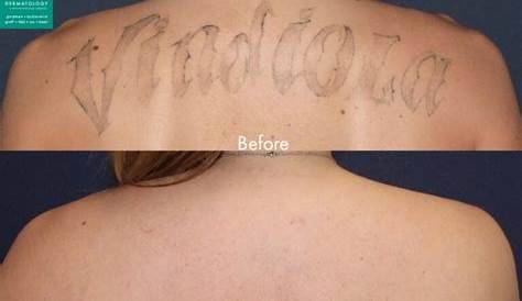 My experience with laser tattoo removal at Medermis in San Antonio