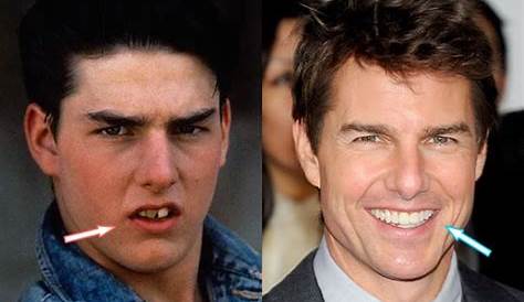 Tom Cruise - Celebrity teeth - before & after - Digital Spy