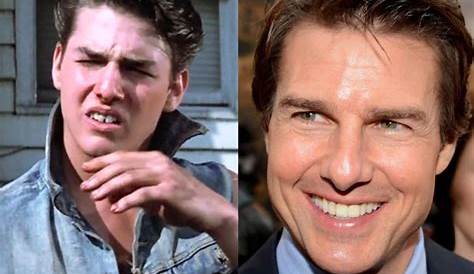 Tom Cruise teeth and Smile Before and After Braces - Headgear Braces