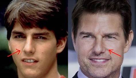 Tom Cruise Plastic Surgery Comparison Photos
