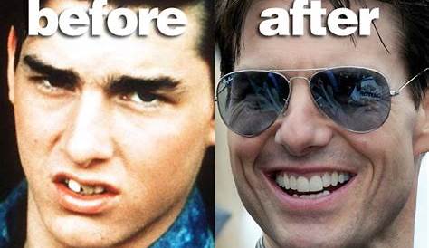 Tom Cruise's Teeth | The London Lingual Orthodontic Clinic