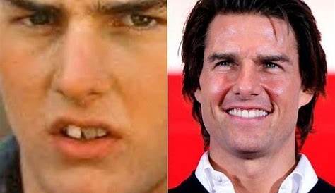 Tom Cruise's before with braces and after his orthodontic treatment