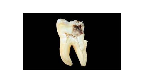Behandlung eines toten Zahns notwendig?