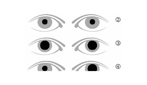 Was kann zu erweiterten Pupillen führen?