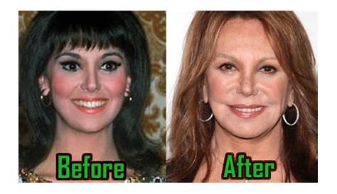 Marlo Thomas Plastic Surgery Before and After Facelift Star Plastic