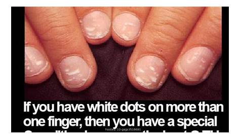 What Is The White Stuff Underneath Your Nails Spots On Causes And