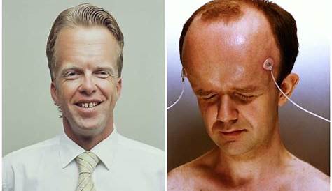 Who has the biggest forehead in the world? Everything you need to know