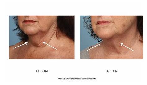 Zplasty Before & After Photos Behr Laser & Skin Care Center