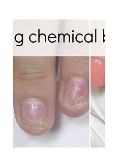 Nails Burn After Acrylic