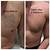 About Laser Tattoo Removal