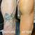 Before And After Laser Tattoo Removal