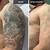 Chest Tattoo Removal Before After