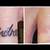 Erased Tattoo Removal
