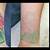 Green Tattoo Removal Before And After