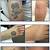 How Effective Is Tattoo Removal