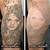 Huge Tattoo Removal