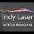 Indy Laser Tattoo Removal