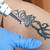 Laser Removal For Tattoos