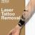 Laser Tattoo Removal Chesterfield