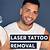 Laser Tattoo Removal Kent