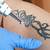 Removal Of Tattoos By Laser
