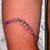 Surgical Removal Tattoo