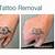 Tattoo Laser Removal Near Me