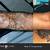 Tattoo Removal African American Skin