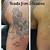 Tattoo Removal Coventry
