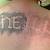 Tattoo Removal Newcastle