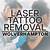 Tattoo Removal Wolverhampton