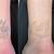 Wrist Tattoo Removal Before And After