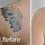 Yag Laser Tattoo Removal Reviews