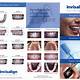 Invisalign Pictures Template