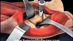 Hip Replacement Surgery