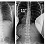 Female Scoliosis Degrees Of Curvature Chart