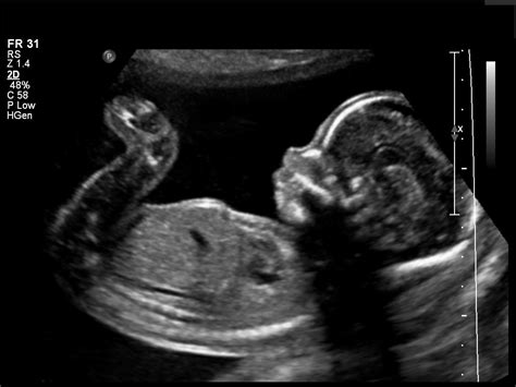 Ultrasound