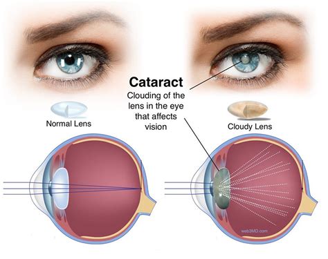 cataract