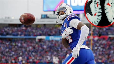1 in 4 former NFL players who died from 2016 to 2021 had degenerative ...