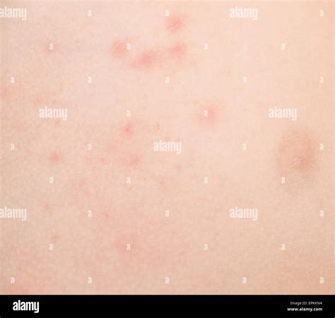 Drug rash on hand hi-res stock photography and images - Alamy