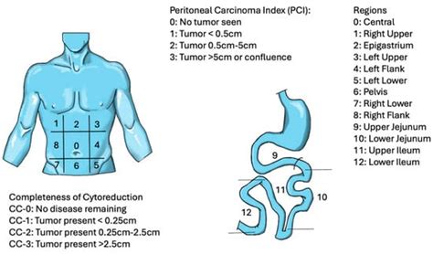 Evolution in the Surgical Management of Gastric Cancer Peritoneal ...