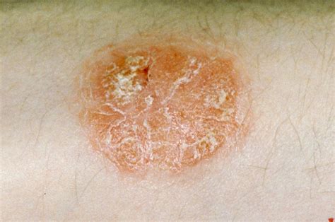Psoriasis Is Unequally Distributed Across The Globe Psoriasis And