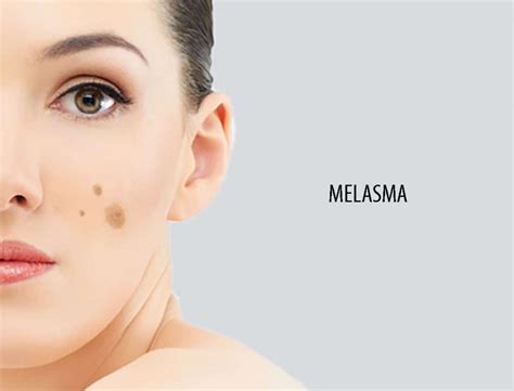 What Is The Best Way To Treat Melasma Prp Is The Future Of Skincare