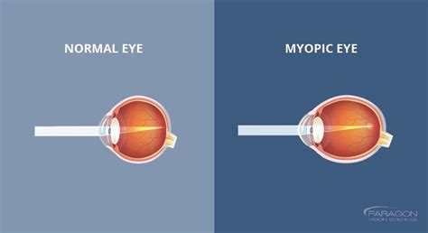 What Exactly Is Nearsightedness Myopia