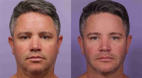 Buccal Fat Removal Before And After Men Women 2024 Gohealthline
