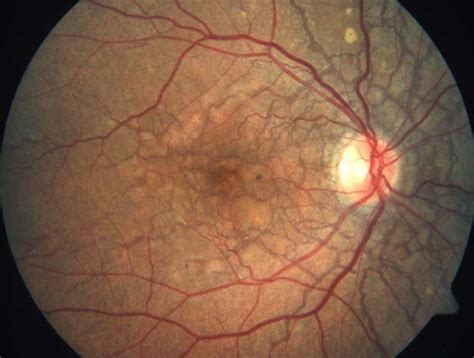 Posterior Segment Differential Diagnoses 23 Westmead Eye Manual