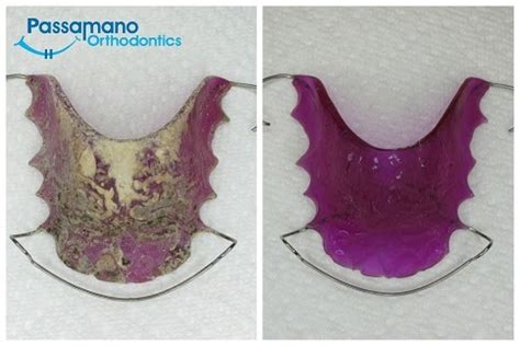 How to clean your retainer. Your Markham Orthodontist, Toronto Invisalign, and ...