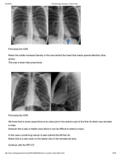 The Radiology Assistant Chest X Ray Basic Interpretation